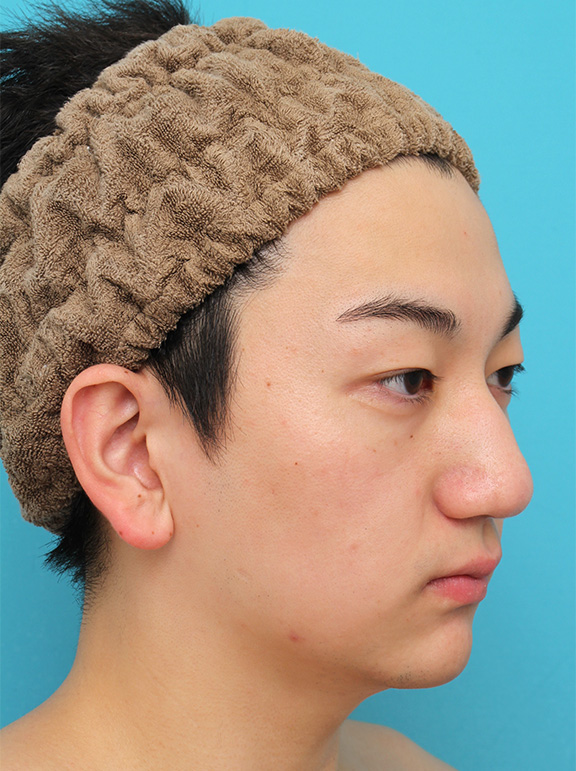 症例写真,垂れ鼻修正+鼻尖縮小+小鼻縮小を行った20代男性の症例写真,After(6ヶ月後),ba_tarebana002_b02.jpg