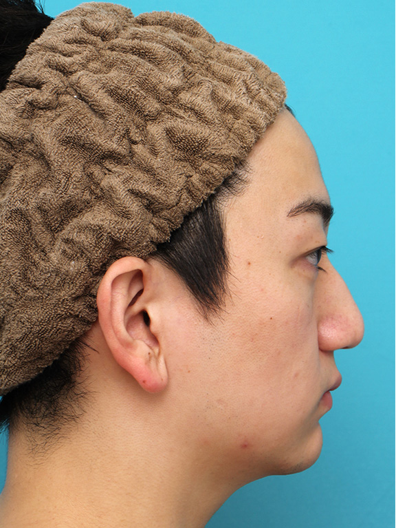 症例写真,垂れ鼻修正+鼻尖縮小+小鼻縮小を行った20代男性の症例写真,After(6ヶ月後),ba_tarebana002_b03.jpg