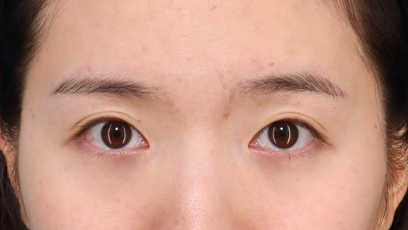 目頭切開,目頭切開で離れ目を改善させた20代女性の症例写真,After（6ヶ月後）,ba_megashira067_a01.jpg