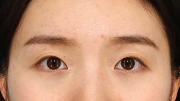 目頭切開,目頭切開で離れ目を改善させた20代女性の症例写真,Before,ba_megashira067_b01.jpg