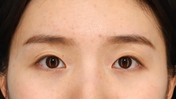 目頭切開,目頭切開で離れ目を改善させた20代女性の症例写真,手術前,mainpic_megashira067a.jpg