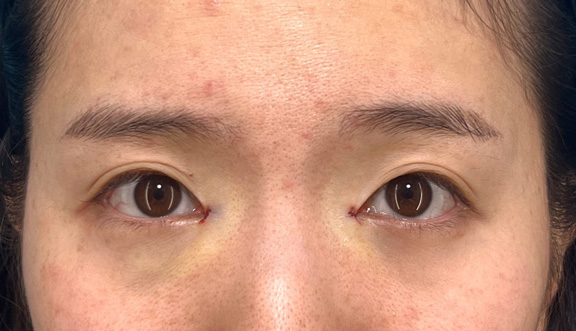 目頭切開,目頭切開で離れ目を改善させた20代女性の症例写真,手術直後,mainpic_megashira067b.jpg