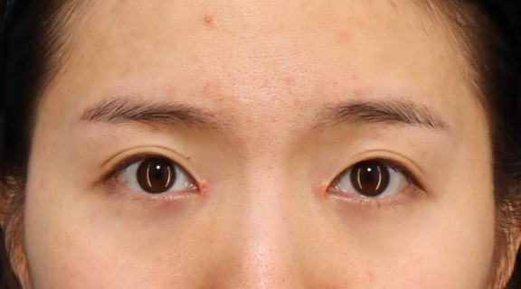 目頭切開,目頭切開で離れ目を改善させた20代女性の症例写真,1週間後,mainpic_megashira067c.jpg