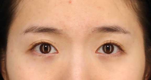 目頭切開,目頭切開で離れ目を改善させた20代女性の症例写真,3週間後,mainpic_megashira067d.jpg