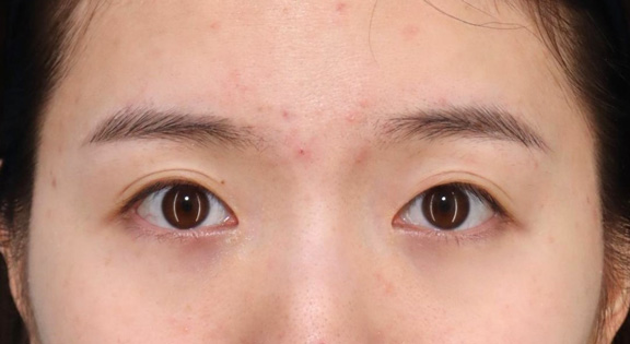 目頭切開,目頭切開で離れ目を改善させた20代女性の症例写真,2ヶ月後,mainpic_megashira067e.jpg