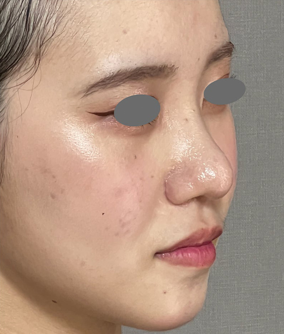 症例写真,小鼻縮小、耳介軟骨移植、鼻尖形成を同時に行った症例写真,After(3ヶ月後),ba_biyoku060_b02.jpg