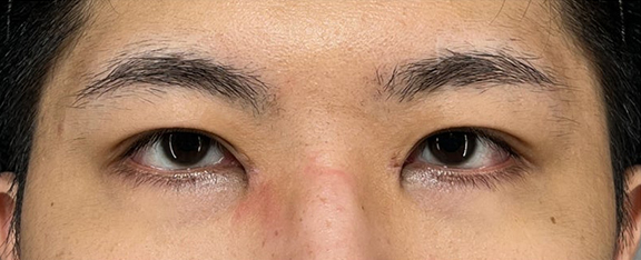 二重まぶた・全切開法,目頭切開,全切開＋目頭切開を同時に行った症例写真,After（1ヶ月後）,ba_sekkai103_a01.jpg