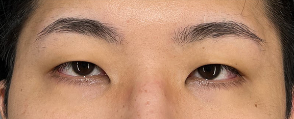 二重まぶた・全切開法,目頭切開,全切開＋目頭切開を同時に行った症例写真,Before,ba_sekkai103_b01.jpg
