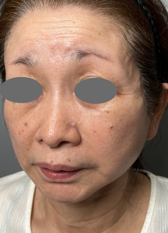 症例写真,ミニ切開リフトを行った症例写真,After(6ヶ月後),ba_minilift022_b02.jpg