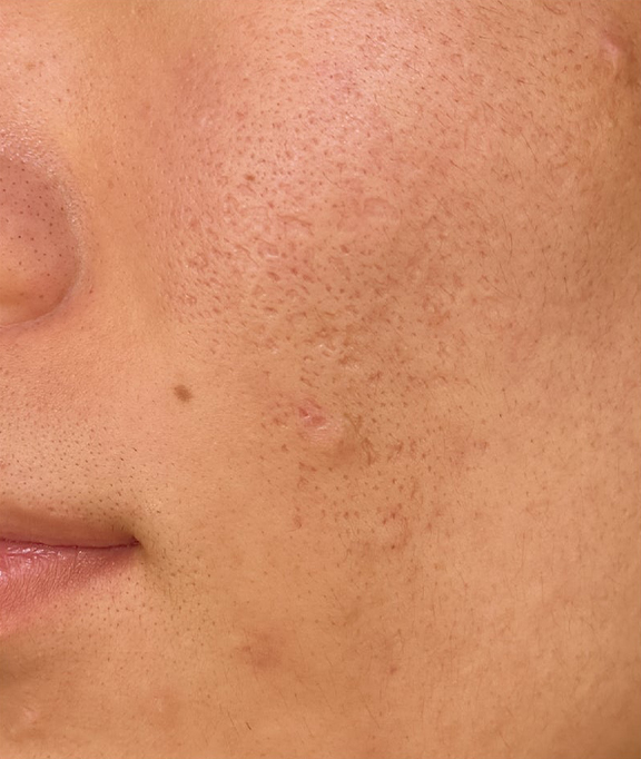 症例写真,サブシジョン+ジュベルックの症例写真,After(2ヶ月後),ba_subcision_juvelook001_b02.jpg