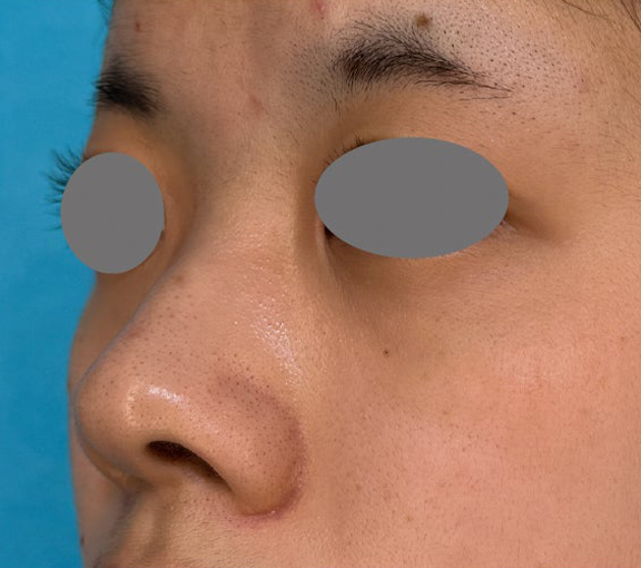 症例写真,耳介軟骨移植・小鼻縮小・鼻尖形成を行って洗練された印象の鼻になった症例写真,Before,ba_jikai058_b02.jpg