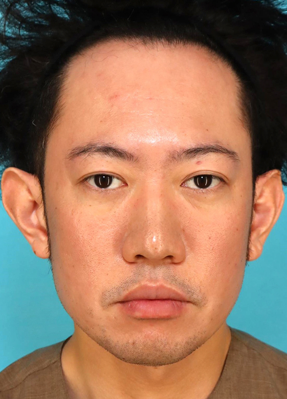 唇を薄く（口唇縮小術）,かなり分厚い唇を手術で薄くした30代男性の症例写真,After（6ヶ月後）,ba_usuku027_a01.jpg