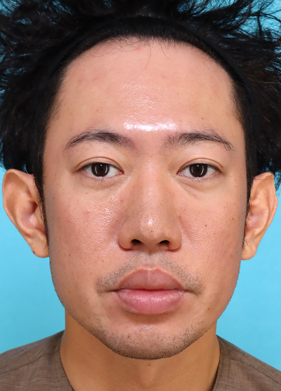 唇を薄く（口唇縮小術）,かなり分厚い唇を手術で薄くした30代男性の症例写真,Before,ba_usuku027_b01.jpg