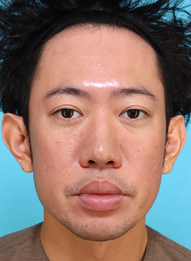 症例写真,かなり分厚い唇を手術で薄くした30代男性の症例写真,手術前,口を閉じた状態,mainpic_usuku027a.jpg
