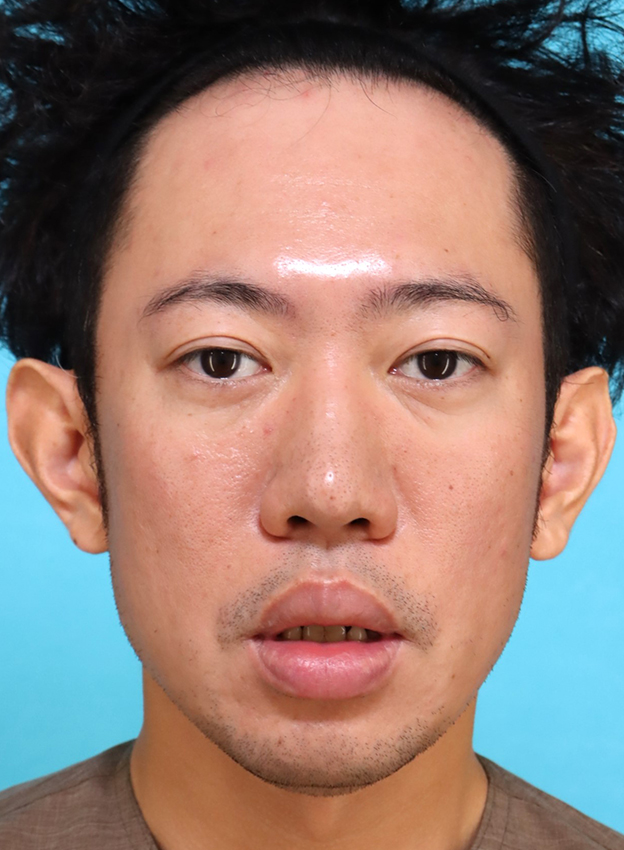 症例写真,かなり分厚い唇を手術で薄くした30代男性の症例写真,手術前,口を開けた状態,mainpic_usuku027b.jpg