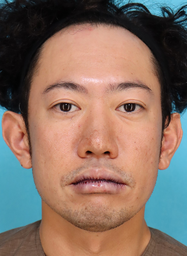 症例写真,かなり分厚い唇を手術で薄くした30代男性の症例写真,手術直後,口を閉じた状態,mainpic_usuku027c.jpg