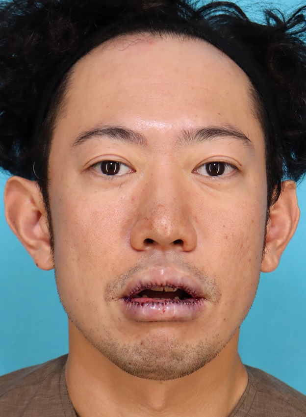 症例写真,かなり分厚い唇を手術で薄くした30代男性の症例写真,手術直後,口を開けた状態,mainpic_usuku027d.jpg