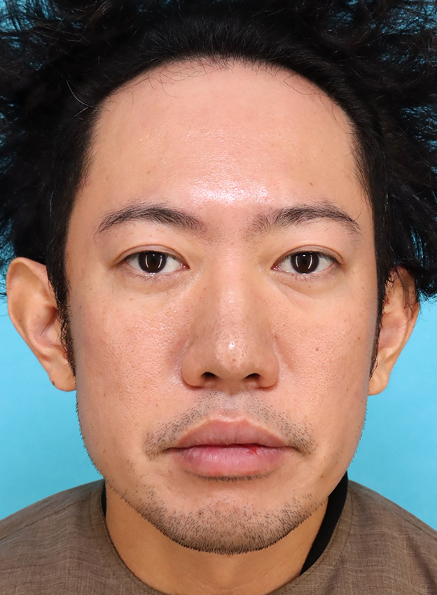 症例写真,かなり分厚い唇を手術で薄くした30代男性の症例写真,10日後,口を閉じた状態,mainpic_usuku027e.jpg
