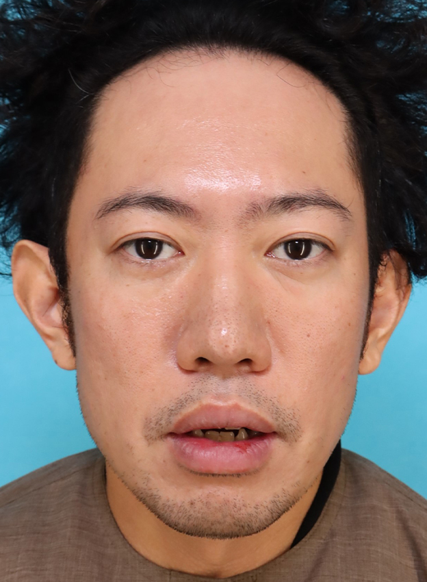 症例写真,かなり分厚い唇を手術で薄くした30代男性の症例写真,10日後,口を開けた状態,mainpic_usuku027f.jpg