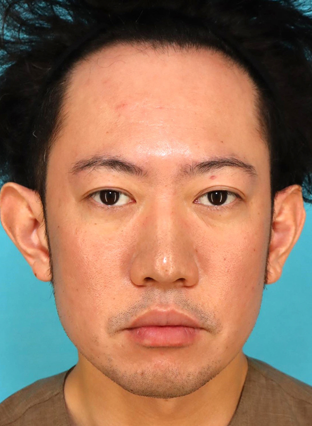 症例写真,かなり分厚い唇を手術で薄くした30代男性の症例写真,6ヶ月後,口を閉じた状態,mainpic_usuku027g.jpg
