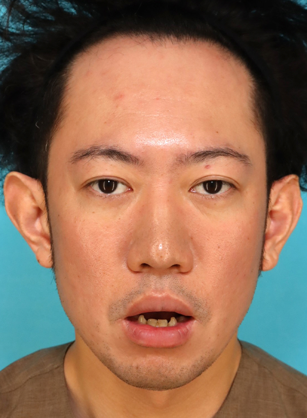 症例写真,かなり分厚い唇を手術で薄くした30代男性の症例写真,6ヶ月後,口を開けた状態,mainpic_usuku027h.jpg