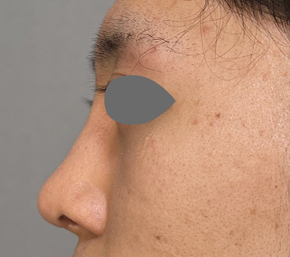症例写真,鼻尖形成+耳介軟骨移植で鼻の高さを出した症例写真,After(3ヶ月後),ba_bisen032_b02.jpg