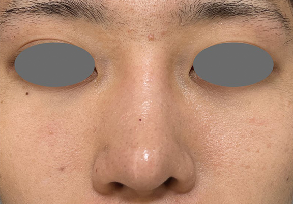 症例写真,鼻尖形成+耳介軟骨移植で鼻の高さを出した症例写真,After(3ヶ月後),ba_bisen032_b03.jpg