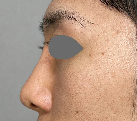 症例写真,鼻尖形成+耳介軟骨移植で鼻の高さを出した症例写真,Before,ba_bisen032_b02.jpg
