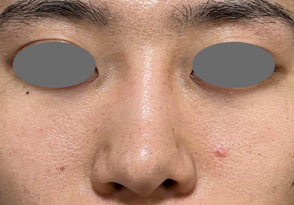 症例写真,鼻尖形成+耳介軟骨移植で鼻の高さを出した症例写真,Before,ba_bisen032_b03.jpg