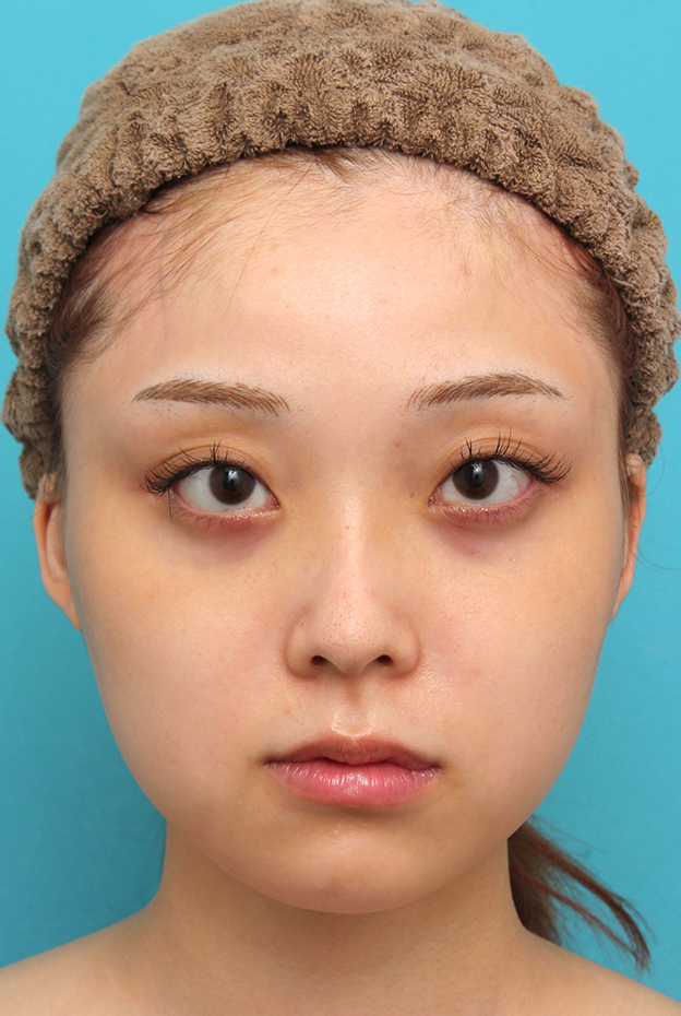 あご形成（シリコンプロテーゼ）,シリコンプロテーゼで顎をシャープに前方に出した20代女性の症例写真,手術前,mainpic_ago028a.jpg