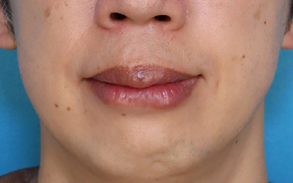 唇を薄く（口唇縮小術）,上下の口唇の厚みに口唇縮小術を行った40代男性の症例写真,After（1ヶ月後）,ba_usuku029_a01.jpg