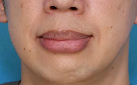 唇を薄く（口唇縮小術）,上下の口唇の厚みに口唇縮小術を行った40代男性の症例写真,Before,ba_usuku029_b01.jpg
