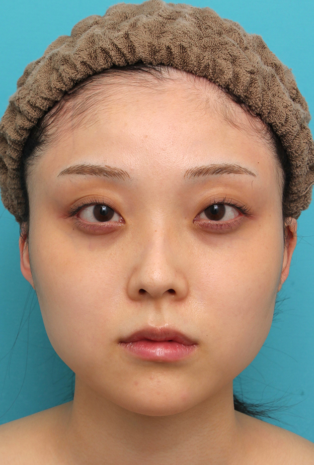 症例写真,エラボトックス注射で小顔になった20代女性の症例写真,注射直後,mainpic_botox_puchi030b.jpg