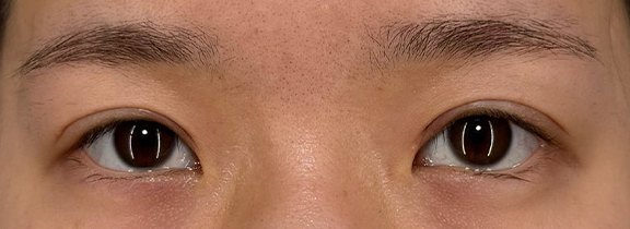 二重まぶた・全切開法,垂れ目（パンダ目）形成（グラマラスライン／下眼瞼下制術）,二重まぶた・全切開法と垂れ目形成でつり上がった目元を優しい印象にした症例写真,After（1ヶ月後）,ba_panda025_a01.jpg