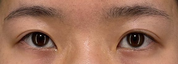 二重まぶた・全切開法,垂れ目（パンダ目）形成（グラマラスライン／下眼瞼下制術）,二重まぶた・全切開法と垂れ目形成でつり上がった目元を優しい印象にした症例写真,Before,ba_panda025_b01.jpg