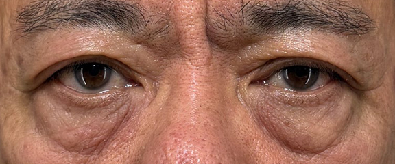 表ハムラ・裏ハムラ法,表ハムラ法でスッキリとした目元になった症例写真,Before,ba_hamra002_b01.jpg