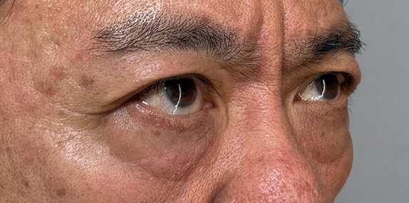 表ハムラ・裏ハムラ法,表ハムラ法でスッキリとした目元になった症例写真,Before,ba_hamra002_b02.jpg