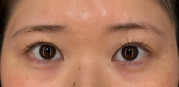 垂れ目形成と目尻切開を行った症例写真,Before,ba_panda026_b01.jpg