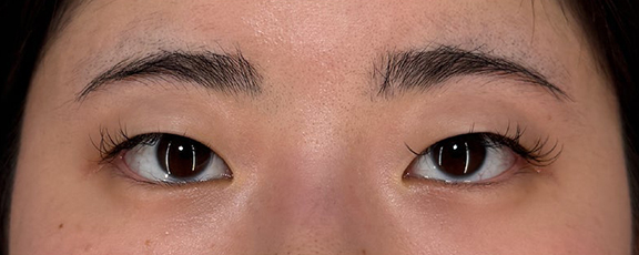 重たい一重まぶたに対して行った二重まぶた・埋没法の症例写真,Before,ba_maibotsu090_b01.jpg