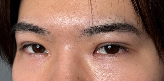 症例写真,二重全切開＋目頭切開で自然な二重を作った20代男性の症例写真,After（3ヶ月後）,ba_sekkai112_b02.jpg