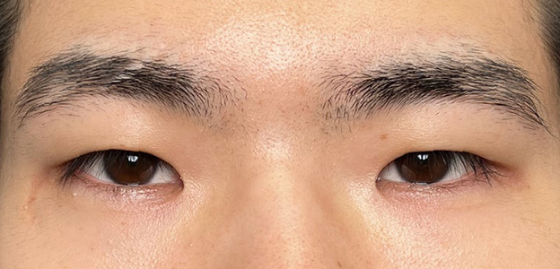 症例写真,二重全切開＋目頭切開で自然な二重を作った20代男性の症例写真,施術前,mainpic_sekkai112a.jpg