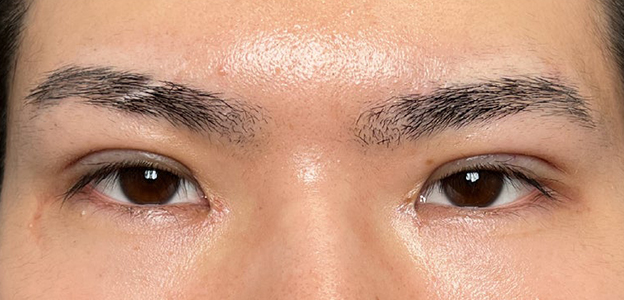 症例写真,二重全切開＋目頭切開で自然な二重を作った20代男性の症例写真,1ヶ月後,mainpic_sekkai112d.jpg