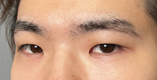 症例写真,二重全切開＋目頭切開で自然な二重を作った20代男性の症例写真,施術前,mainpic_sekkai112f.jpg