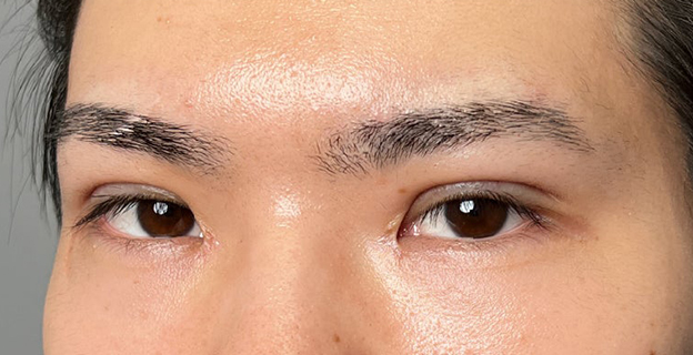 症例写真,二重全切開＋目頭切開で自然な二重を作った20代男性の症例写真,1ヶ月後,mainpic_sekkai112i.jpg