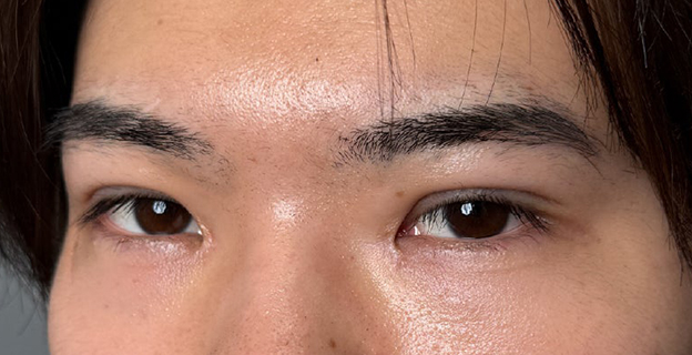 症例写真,二重全切開＋目頭切開で自然な二重を作った20代男性の症例写真,3ヶ月後,mainpic_sekkai112j.jpg