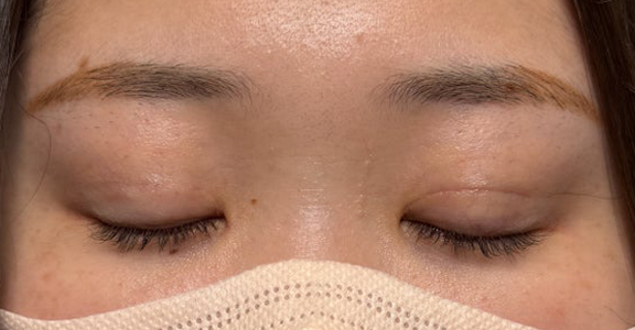 症例写真,埋没法で取れてしまった二重を、全切開法で希望の幅に整えた20代女性の症例写真,After（目を閉じた状態）<br/>
（3ヶ月後）,ba_sekkai113_b03.jpg