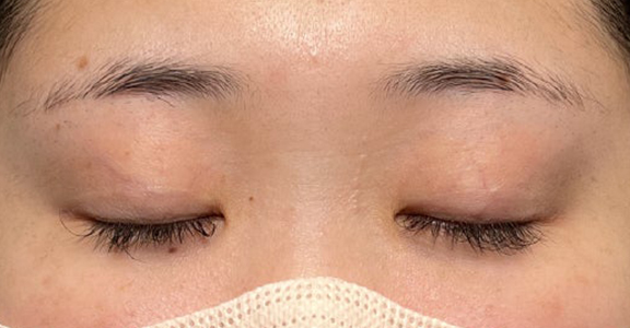 症例写真,埋没法で取れてしまった二重を、全切開法で希望の幅に整えた20代女性の症例写真,Before,ba_sekkai113_b03.jpg