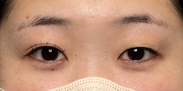 症例写真,埋没法で取れてしまった二重を、全切開法で希望の幅に整えた20代女性の症例写真,施術前,futaezensekkai1_1.jpg