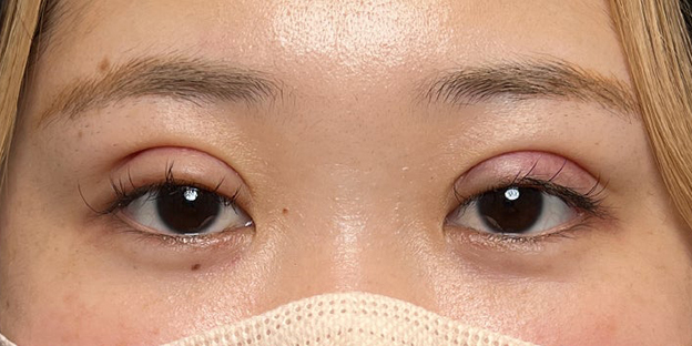 症例写真,埋没法で取れてしまった二重を、全切開法で希望の幅に整えた20代女性の症例写真,抜糸後（1週間後）,futaezensekkai1_3.jpg
