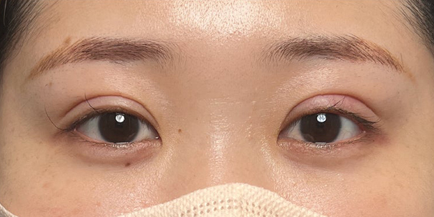 症例写真,埋没法で取れてしまった二重を、全切開法で希望の幅に整えた20代女性の症例写真,1ヶ月後,futaezensekkai1_4.jpg